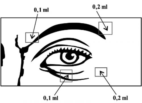 Как долго длится восстановление после процедуры диспорта