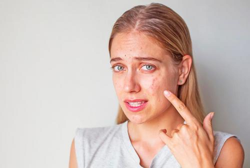 Прыщи на лице после 40 лет у женщин. Акне в зрелом возрасте, как с этим бороться?
