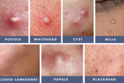 Прыщи на лице после 40 лет у женщин. Акне в зрелом возрасте, как с этим бороться?