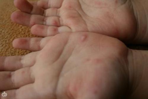 Подростковые прыщи у девочек. Причины появления подростковых прыщей 05