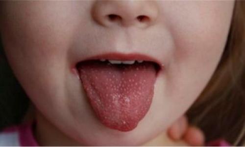 Подростковые прыщи у девочек. Причины появления подростковых прыщей 04