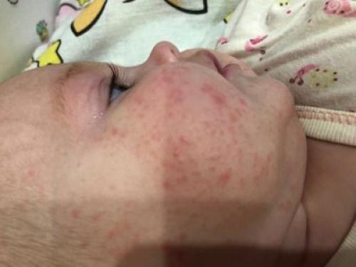 Подростковые прыщи у девочек. Причины появления подростковых прыщей 02