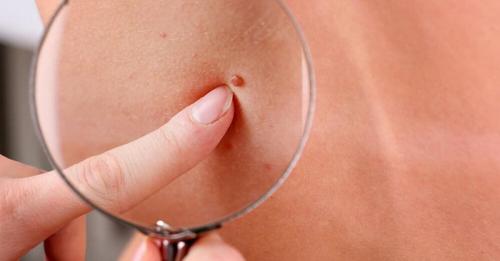 IMAGE-SKINCARE.RU » акне на спине и в зоне декольте. Лечение акне фототерапией 03 IMAGE-SKINCARE.RU » акне на спине и в зоне декольте. Лечение акне фототерапией 03