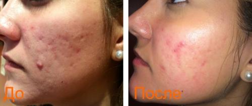 Blackheads Removal Удаление прыщей. Лазерное удаление прыщей на коже лица