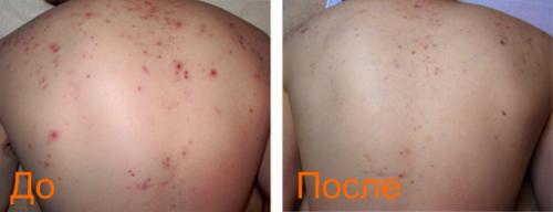 Blackheads Removal Удаление прыщей. Лазерное удаление прыщей на коже лица