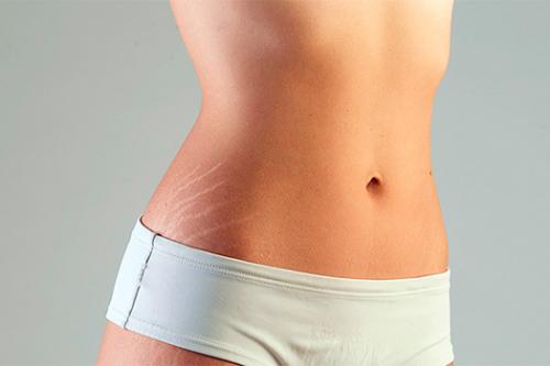 Можно ли избавиться от растяжек после родов. Домашняя работа 02 Можно ли избавиться от растяжек после родов. Домашняя работа 02