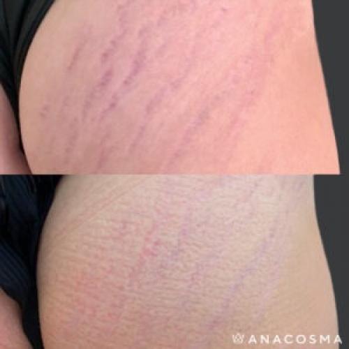 Растяжки появились через месяц после родов. 5 эффективных методик, которые помогут убрать растяжки после родов