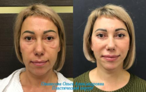 Блефаропластика при грудном вскармливании. Блефаропластика