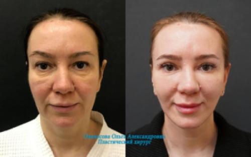 Блефаропластика при грудном вскармливании. Блефаропластика