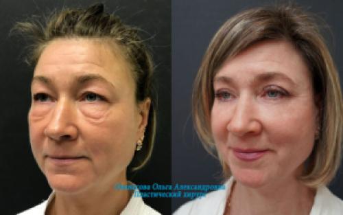 Блефаропластика при грудном вскармливании. Блефаропластика