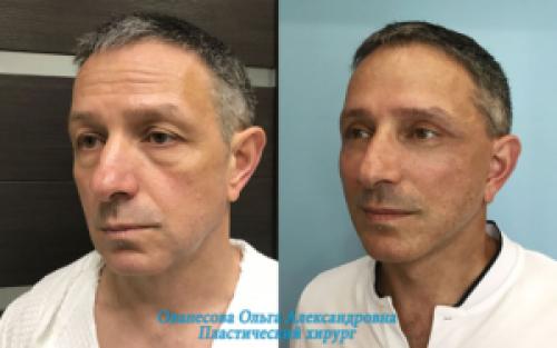 Блефаропластика при грудном вскармливании. Блефаропластика