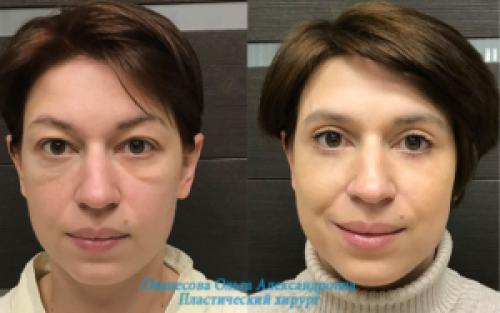 Блефаропластика при грудном вскармливании. Блефаропластика