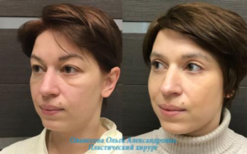 Блефаропластика при грудном вскармливании. Блефаропластика