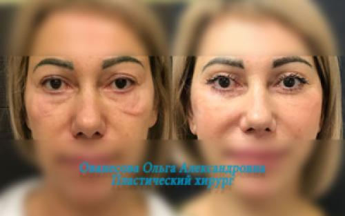 Блефаропластика при грудном вскармливании. Блефаропластика