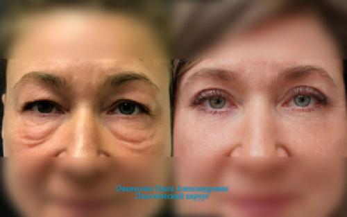 Блефаропластика при грудном вскармливании. Блефаропластика