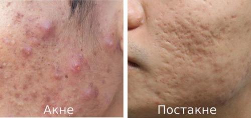 Как избавиться от пятен от прыщей. Как избавиться от пятен после акне с помощью косметологии 02 Как избавиться от пятен от прыщей. Как избавиться от пятен после акне с помощью косметологии 02