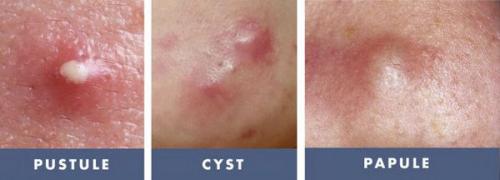 Как избавиться от пятен от прыщей. Как избавиться от пятен после акне с помощью косметологии 03 Как избавиться от пятен от прыщей. Как избавиться от пятен после акне с помощью косметологии 03