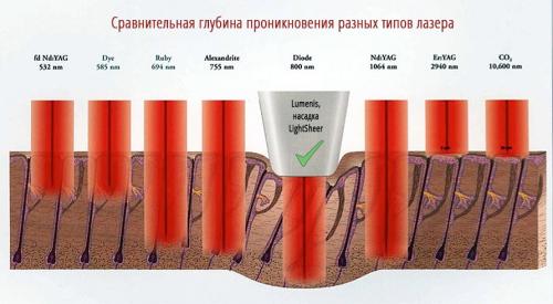 Почему после лазера нельзя загорать. Какие методики относятся к избавлению от волос навсегда? 03 Почему после лазера нельзя загорать. Какие методики относятся к избавлению от волос навсегда? 03