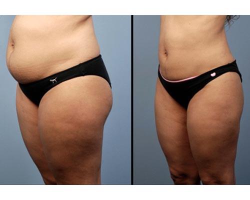 Как с помощью массажа подтянуть живот после родов. Как убрать живот после родов? 03 Как с помощью массажа подтянуть живот после родов. Как убрать живот после родов? 03