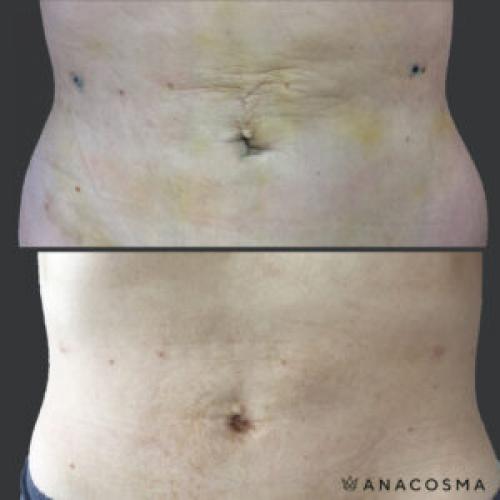 Как с помощью массажа подтянуть живот после родов. Как убрать живот после родов?