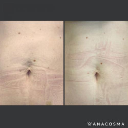 Как с помощью массажа подтянуть живот после родов. Как убрать живот после родов?