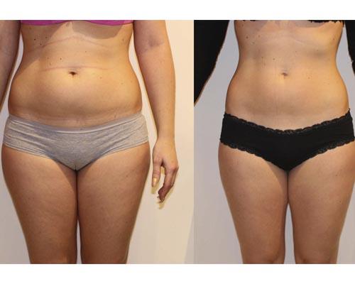 Как с помощью массажа подтянуть живот после родов. Как убрать живот после родов? 04 Как с помощью массажа подтянуть живот после родов. Как убрать живот после родов? 04