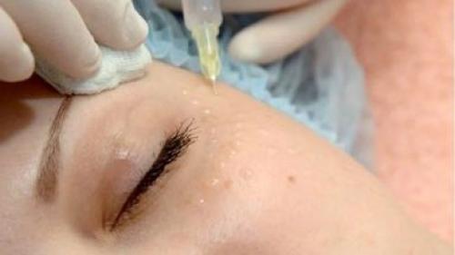 Периорбитальная область и все зоны вокруг глаз. Самые частые проблемы кожи вокруг глаз 02 Периорбитальная область и все зоны вокруг глаз. Самые частые проблемы кожи вокруг глаз 02