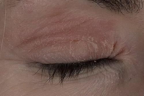 Кожа вокруг глаз. Особенности кожи век