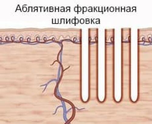 Лазерное омоложение век с эффектом блефаропластики. Что такое лазерное омоложение век, и почему его называют термолифтингом глаз 02 Лазерное омоложение век с эффектом блефаропластики. Что такое лазерное омоложение век, и почему его называют термолифтингом глаз 02