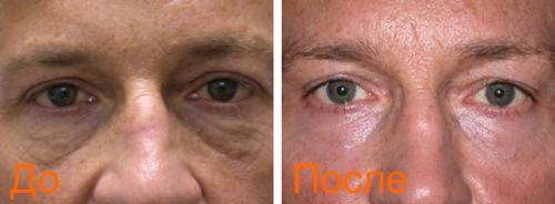 Лазерная блефаропластика москва. Безоперационная блефаропластика лазером