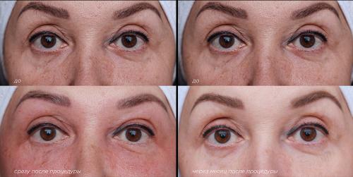 Лазерная блефаропластика до и после. Лазерная блефаропластика на СО2 лазере или классическая пластика век —, что выбрать?