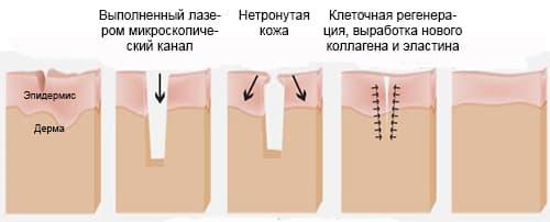 Лазерное омоложение век с эффектом блефаропластики. Что такое лазерное омоложение век, и почему его называют термолифтингом глаз 03 Лазерное омоложение век с эффектом блефаропластики. Что такое лазерное омоложение век, и почему его называют термолифтингом глаз 03