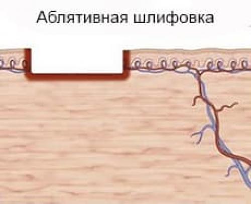 Лазерное омоложение век с эффектом блефаропластики. Что такое лазерное омоложение век, и почему его называют термолифтингом глаз 01 Лазерное омоложение век с эффектом блефаропластики. Что такое лазерное омоложение век, и почему его называют термолифтингом глаз 01