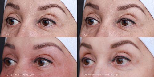 Лазерная блефаропластика до и после. Лазерная блефаропластика на СО2 лазере или классическая пластика век —, что выбрать?