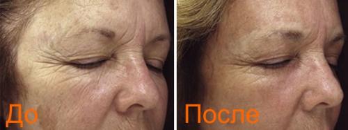 Лазерная блефаропластика москва. Безоперационная блефаропластика лазером