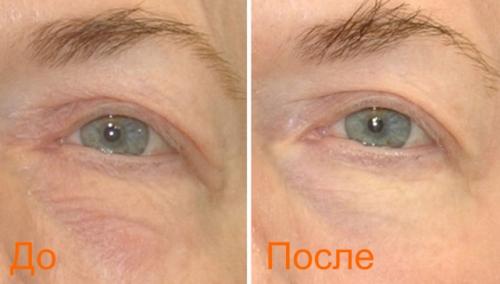 Лазерная блефаропластика москва. Безоперационная блефаропластика лазером