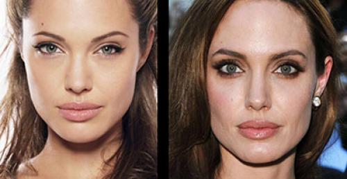 Причины раннего старения периорбитальной области. Старение периорбитальных областей 01