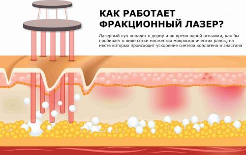 Фракционный лазер до и после. Как работает фракционный лазер СО2 ?