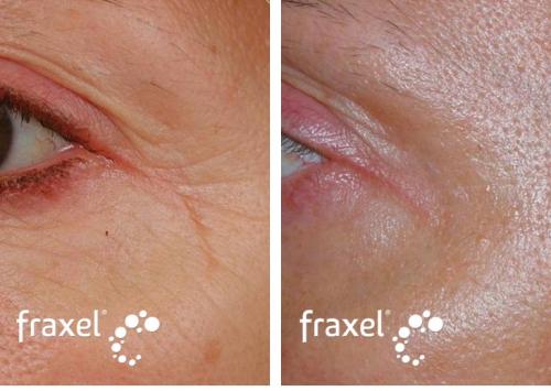 Фракционный лазер до и после. Что такое лазерное омоложение fraxel ?