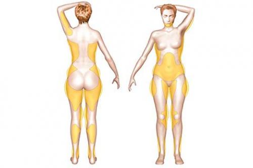 При каком проценте жира виден пресс у женщин. Возвращается ли жир после липосакции и сколько длится результат?