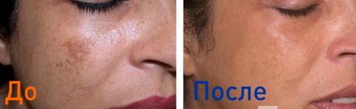 Фракционная лазерная шлифовка до и после. Шлифовка лица фракционным лазером