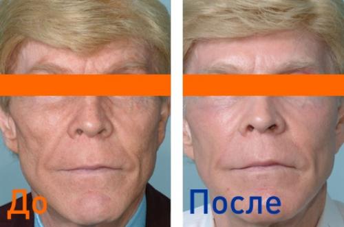 Фракционная лазерная шлифовка до и после. Шлифовка лица фракционным лазером