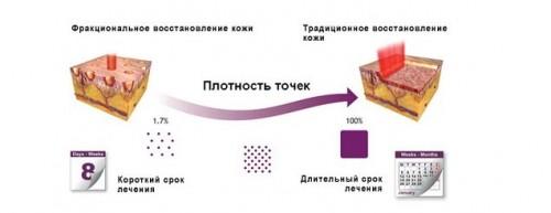 Особенности омоложения лица CO2 лазером. Фракционное омоложение со2