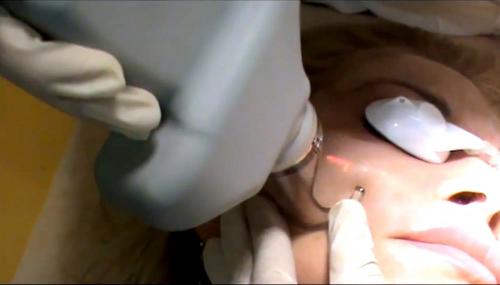 Что такое фракционное лазерное омоложение. Фракционное омоложение СО2 лазером: свойства и цели применения 01 Что такое фракционное лазерное омоложение. Фракционное омоложение СО2 лазером: свойства и цели применения 01