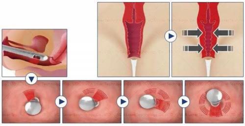 Что такое фракционное лазерное омоложение. Фракционное омоложение СО2 лазером: свойства и цели применения 03 Что такое фракционное лазерное омоложение. Фракционное омоложение СО2 лазером: свойства и цели применения 03