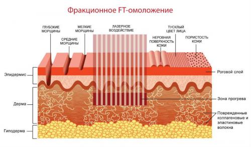 Фракционное омоложение противопоказания. Чем фракционное омоложение лица отличается от лазерной шлифовки и других процедур