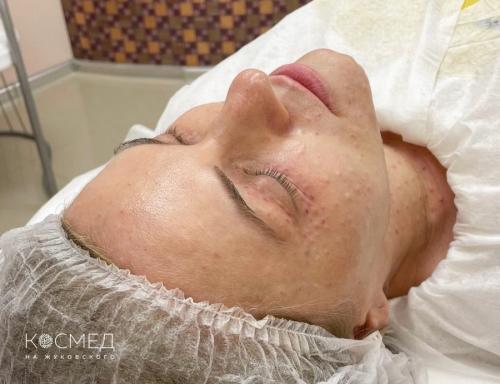 Какие хирургические методы помогают убрать морщины вокруг глаз. Инъекционные методики