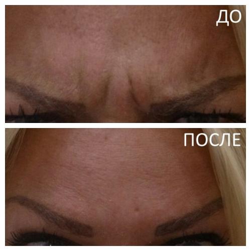 Когда подействует ботокс в межбровье. Основные показания к применению Ботокса 01