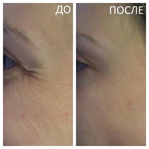 Когда подействует ботокс в межбровье. Основные показания к применению Ботокса 02