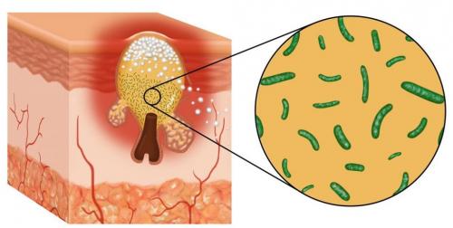 Средства от пятен после прыщей. Причины развития акне